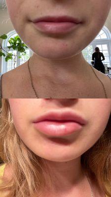 Lip filler results