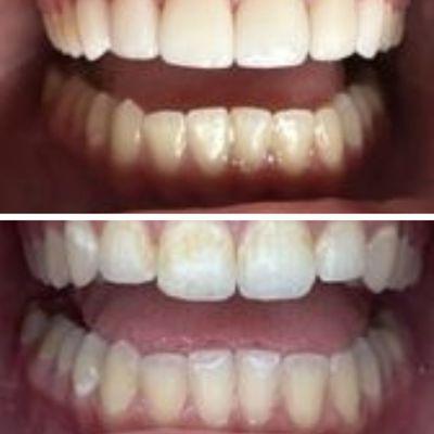 Before and after with veneers