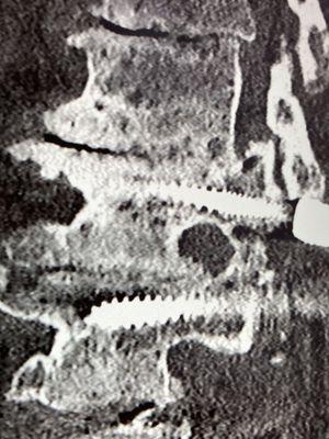 Failing and mobile titanium spine screws