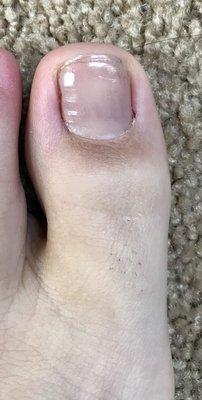 Toe today (12/22/17) I couldn't be happier with how my toe healed.