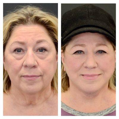 Facelift along with upper and lower eyelid surgery..