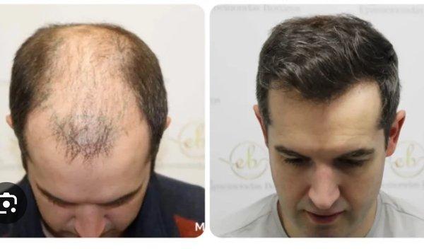 Non-surgical hair replacement