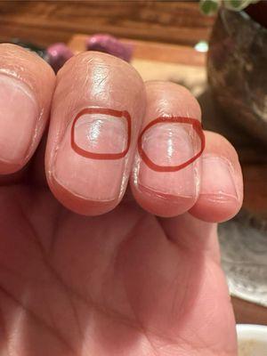 Damaged and thinned at the base of my nails