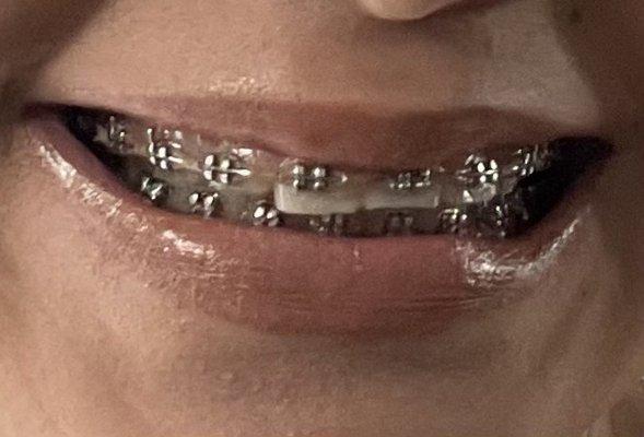 Teeth after 5+ years still not straight.