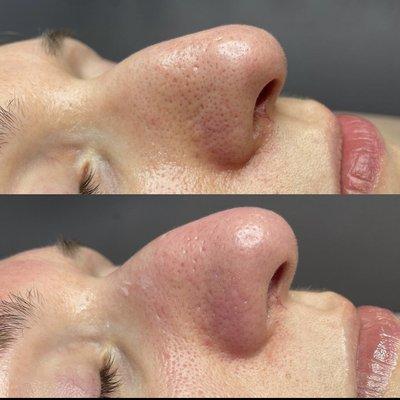 Facial before & After nose extractions