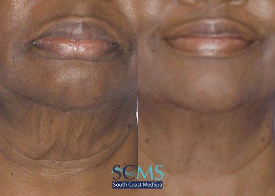 Morpheus8 Skin Treatment - Neck