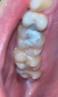 My new top fillings