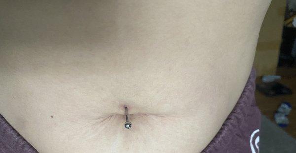 Incorrectly pierced belly piercing