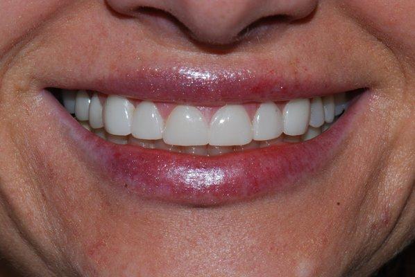 After Veneers