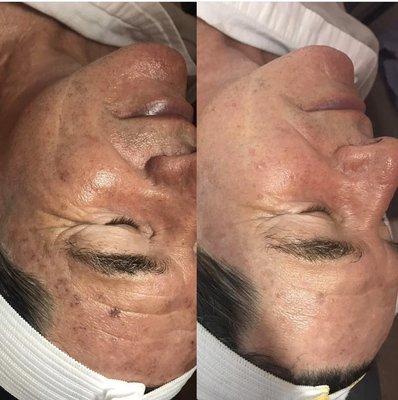 Before and after rezenerate nanofacial with an enzyme peel