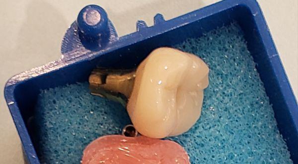 Implant crown and abutment. The appearance and fit was perfect.