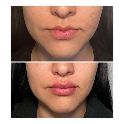 Gradually building up "m" shaped lips with small amounts of filler over several appointments is the key.