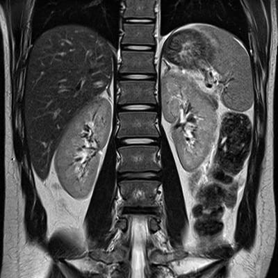 Chest MRI