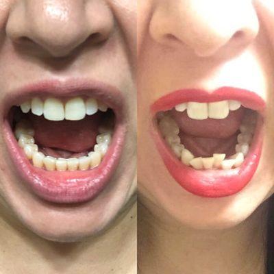 My before and after Invisalign.