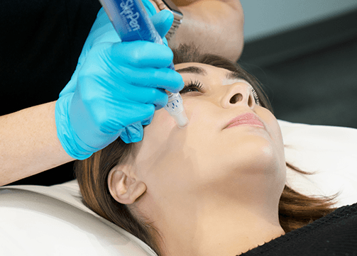 micro-needling