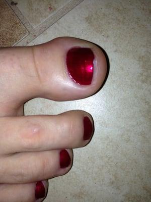 Jagged toenail...