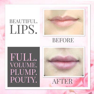 Beautiful Lip Enhancement