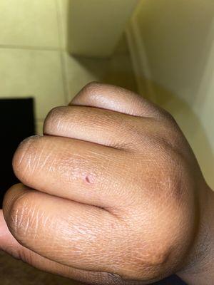 Cat Tooth Went In Finger