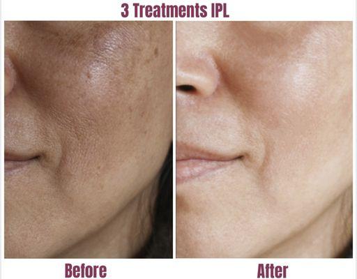 Goodbye Melasma, hello clear skin!  Amazing results in just 3 treatments; lighten and brighten!!