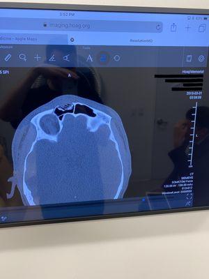 Severely fractured frontal sinus from near-fatal 30min attack. NBPD ex-Marine thug detectives corrupted case to save their Marine buddy