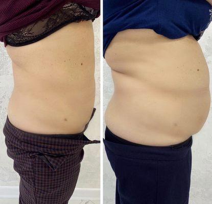 Lipolytics for stubborn fat areas