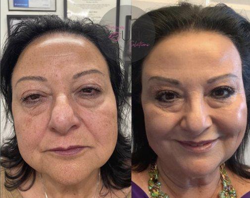 Ful face rejuvenation, Opus Plasma, Juvederm Volume, Revanesse Lips