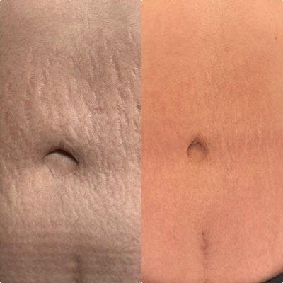 Stretch Mark Treatment