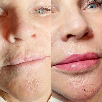 Lip asymmetry correction & revitalization