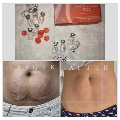 We can help the stubborn mommy tummy with Kybella and Microneedling