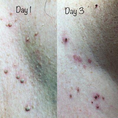 Skin tag removal