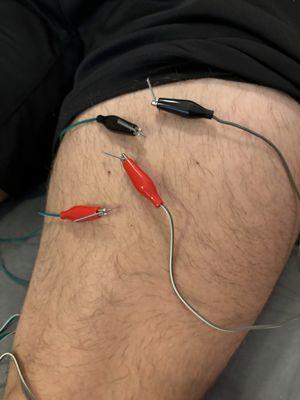 Dry needling as treatment for subacute hamstring strain.