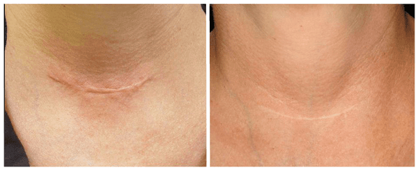 Laser Genesis™ helps reduce the appearance of superficial scars.