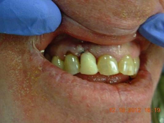 Tooth be extracted-implant placed with temporary crown