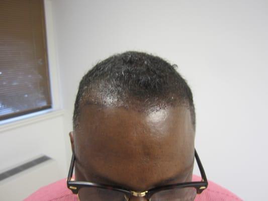 Hair Transplant BEFORE