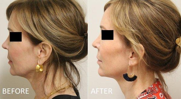 Before & After Facelift, Endoscopic Browlift performed by Dr. Albert Chow