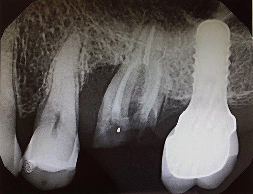 Before surgery. Tooth was taken out and grafted. Implant was placed 6m later.