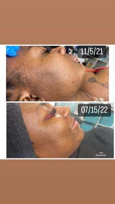 Consistent Skin treatments = RESULTS