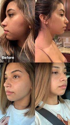 Non-Surgical Rhinoplasty