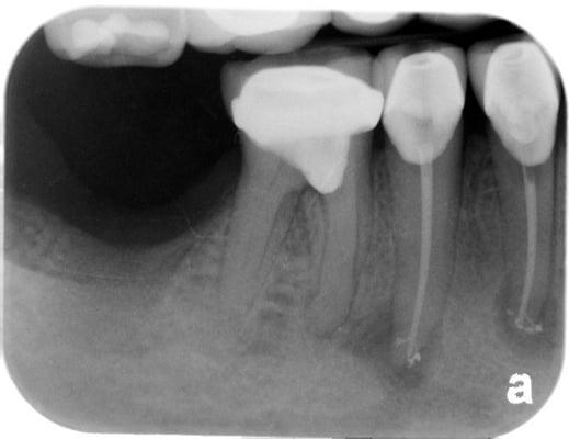 We perform Root Canals