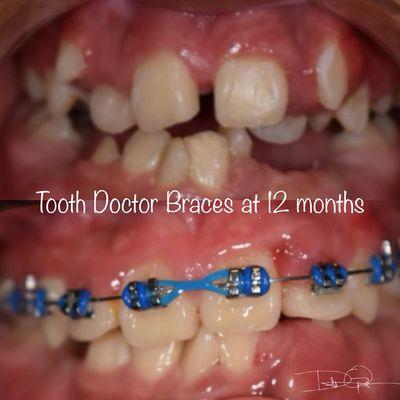 Tooth Doctor braces at 12 months