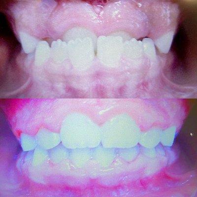 Under bite correction !