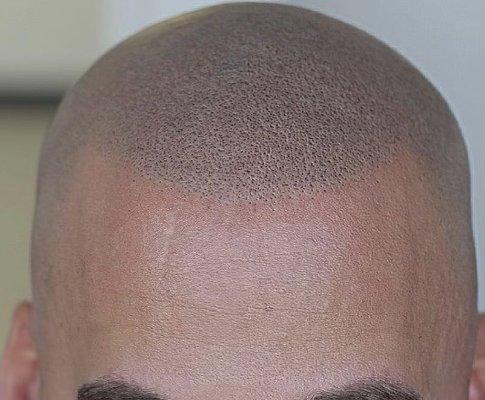 Micro scalp pigmentation after photo.