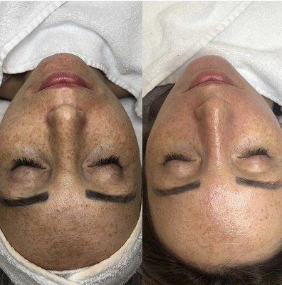 Glow Facial W/microdermabrasion.