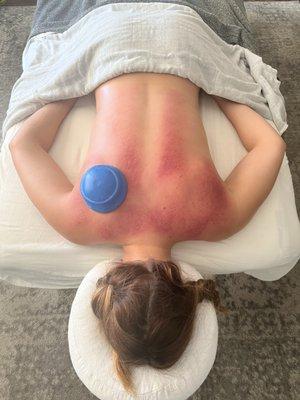 Cupping done right (sliding cupping is so much keep effective than the stagnant, cupping that leaves perfect circles)