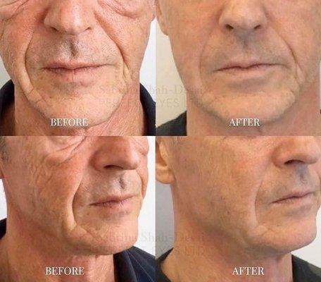 Morpheus 8 is a safe treatment option that utilizes radio frequency  to give the face, neck, and body a youthful appearance. 
Wha