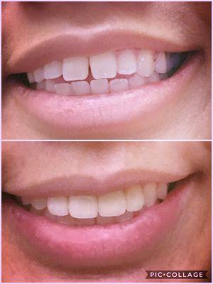 Open bite, and gaps due to tongue trusting, porcelain veneers done