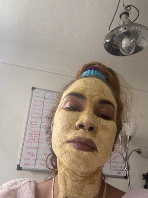 8 days after threads organic turmeric mask to reduce swelling   Chin and skin looks great.