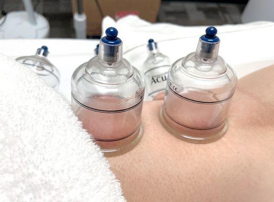 Cupping Treatment!