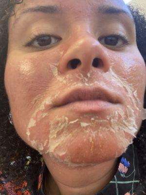 Chemical peel