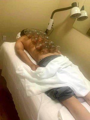 Back pain acupuncture